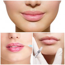 Увеличение и коррекция формы губ